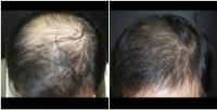 Dermaheal HL