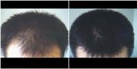 Dermaheal HL