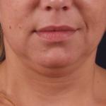 Ošetření facelift přístrojem Exilis