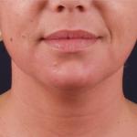 Ošetření facelift přístrojem Exilis