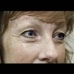 Ošetření facelift přístrojem Exilis