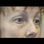 Ošetření facelift přístrojem Exilis