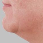 Ošetření facelift přístrojem Exilis