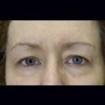 Ošetření facelift přístrojem Exilis