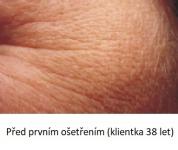 Lasocare - před prvním ošetření proti vráskám