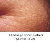 Lasocare - po prvním ošetření proti vráskám