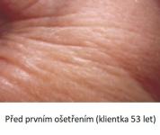Lasocare - před prvním ošetření proti vráskám