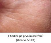 Lasocare - po prvním ošetření proti vráskám