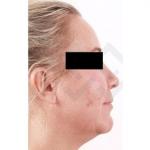 Facelift obličeje